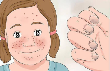 結(jié)節(jié)性硬化癥