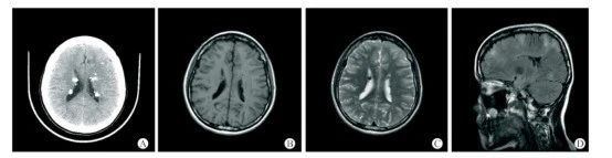結(jié)節(jié)性硬化癥
