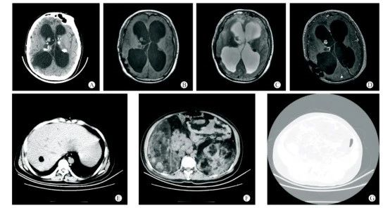 結(jié)節(jié)性硬化癥
