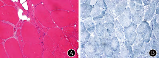 肯尼迪病(KD)——機理研究