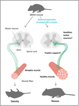 肯尼迪病(KD)——機理研究