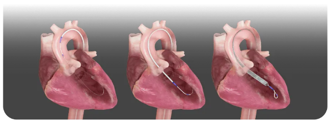 融資7.6億！全球最小介入心臟泵