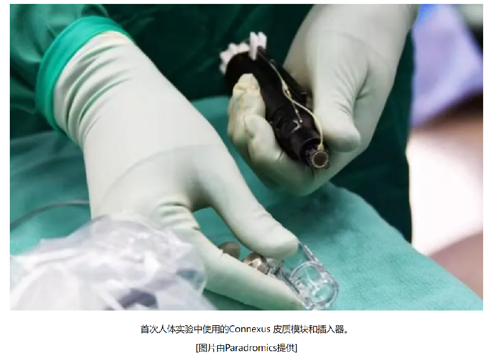 【海外風(fēng)雲(yún)】Paradromics 報(bào)告首次在人體上進(jìn)行Connexus BCI手術(shù)