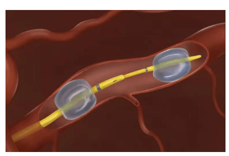 【海外風雲(yún)】RenovoRx 報告了上市后注冊研究中首次使用RenovoCath的患者手術-江蘇網(wǎng)站制作